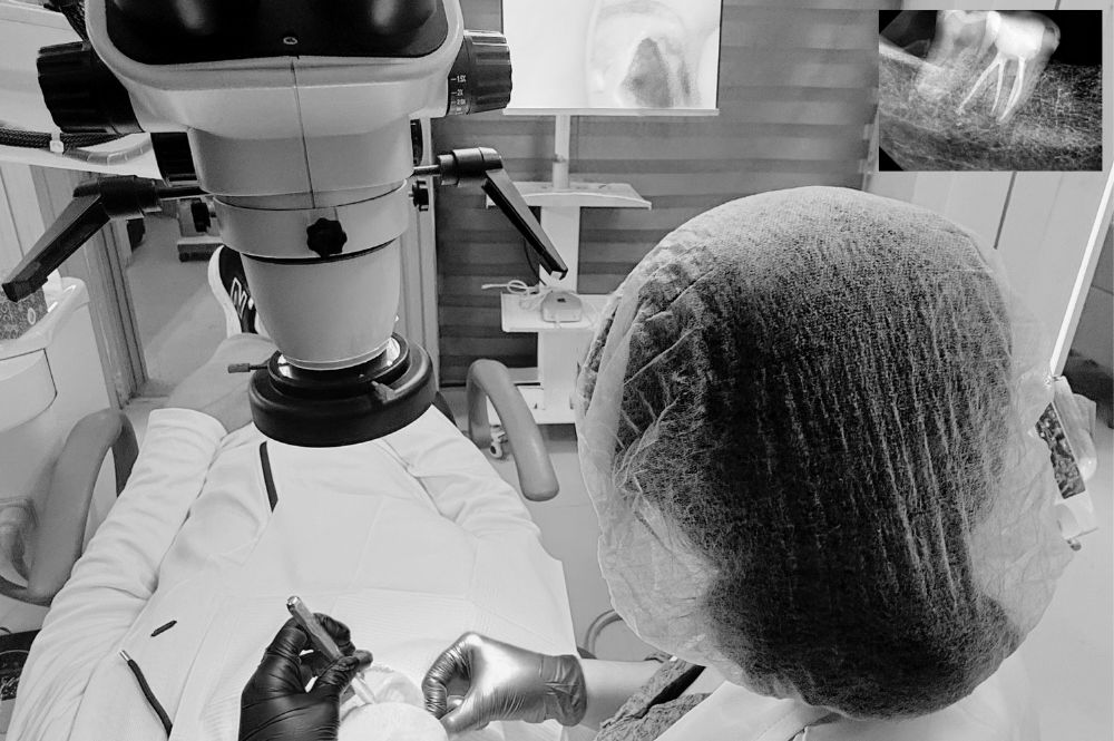 Root Canal Treatment